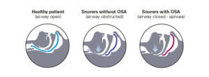 snoring-apnoea-upper-airway-mechanism-resmed