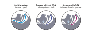 the-airway-when-you-snore-apnoea