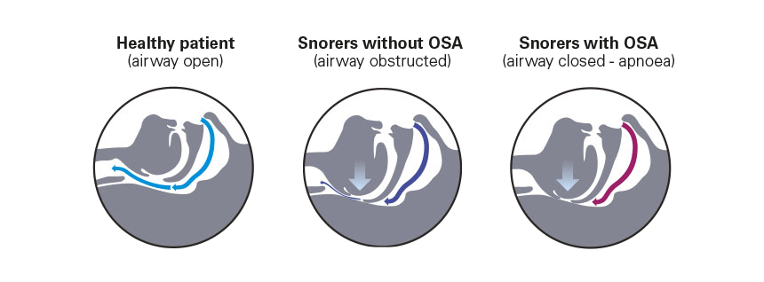 the-airway-when-you-snore-apnoea